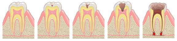 虫歯の進行図